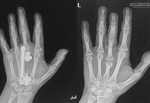 جراحة ميكروسكوبية دقيقة تُنهي معاناة عشرينية من تشوه خلقي باليدين في مستشفى الحبيب بالخبر