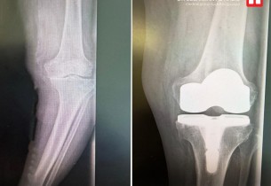 استبدال مفصل الركبة يُنهي معاناة مسن بمستشفى الحبيب في الخبر