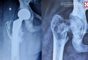استئصال ورم وزراعة مفصل صناعي يعيدان الحركة لمريضة سرطان بعد معاناة طويلة
