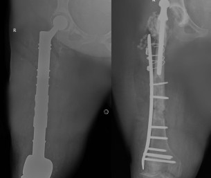مستشفى الحبيب بالخبر يستبدل مفصلي الركبة والورك وعظمة الفخذ ويعيد “الحركة” لـ”ستينية”