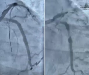 مستشفى الحبيب بالخبر ينقذ حياة مراجع توقف قلبه بسبب انسداد كلي للشريان النازل