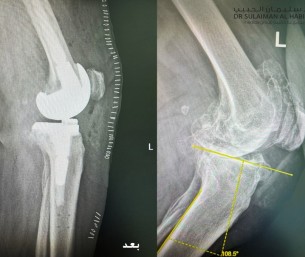مستشفى الحبيب بالخبر يُجري عملية زراعة مفصل معقدة لإعادة قدرة المشي لثمانينية