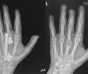 جراحة ميكروسكوبية دقيقة تُنهي معاناة عشرينية من تشوه خلقي باليدين في مستشفى الحبيب بالخبر