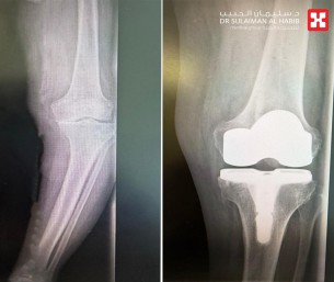 استبدال مفصل الركبة يُنهي معاناة مسن بمستشفى الحبيب في الخبر