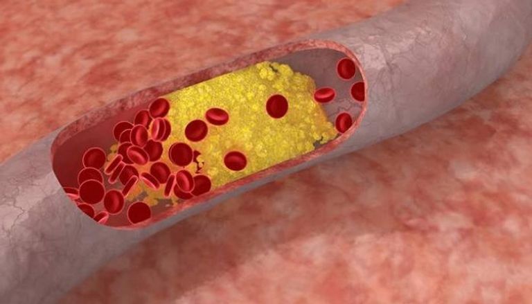 تصلب الشرايين.. 8 أسباب تزيد احتمالات الإصابة