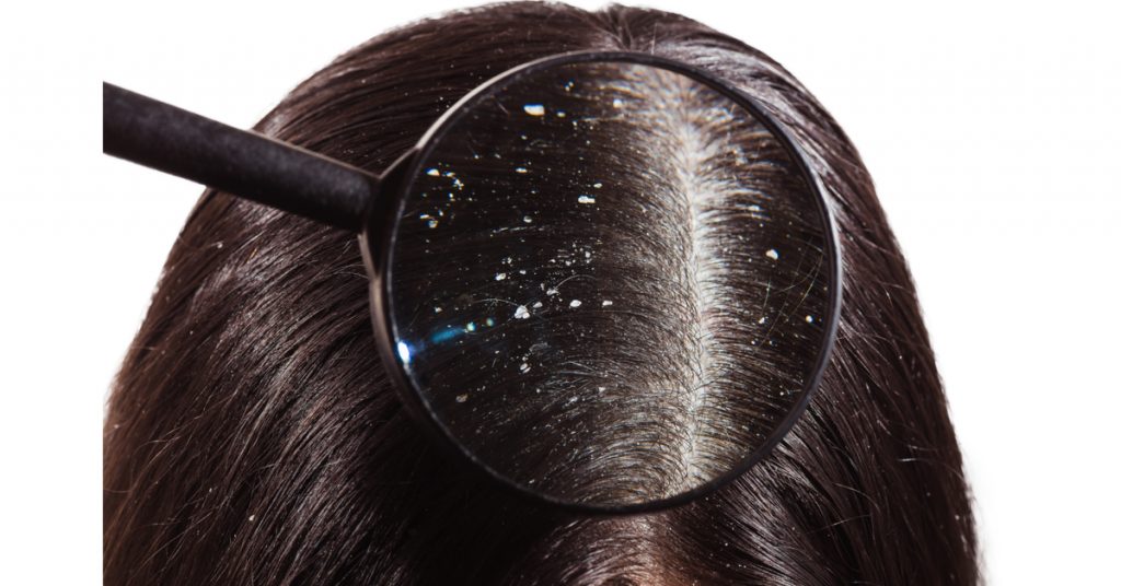 أنواع قشرة الشعر وكيفية الوقاية منها