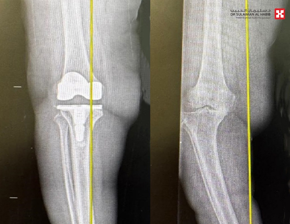 نجاح أول عملية استبدال ركبة بالروبوت الجراحي في مستشفى الدكتور سليمان الحبيب بالخبر