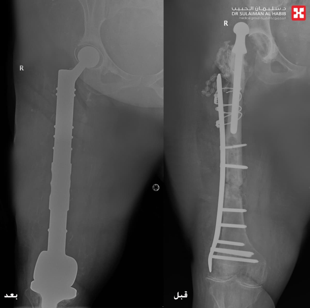 مستشفى الحبيب بالخبر يستبدل مفصلي الركبة والورك وعظمة الفخذ ويعيد “الحركة” لـ”ستينية”