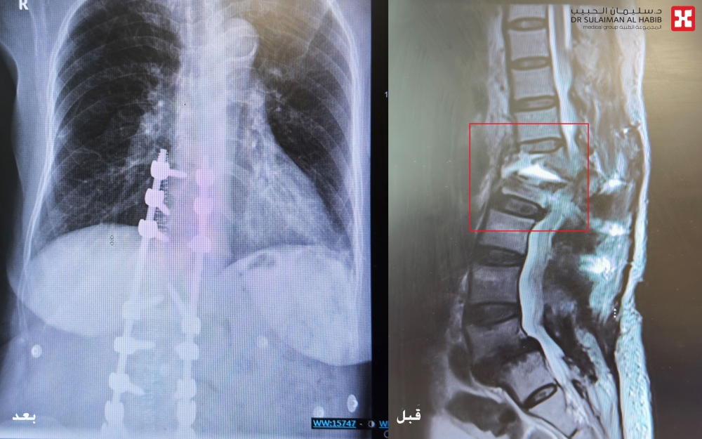 بعد 5 محاولات جراحية لم تنجح.. مستشفى الحبيب بالخبر يُمكّن سبعينية من المشي مجددًا