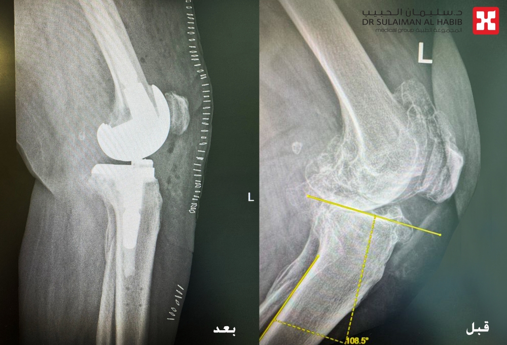 مستشفى الحبيب بالخبر يُجري عملية زراعة مفصل معقدة لإعادة قدرة المشي لثمانينية