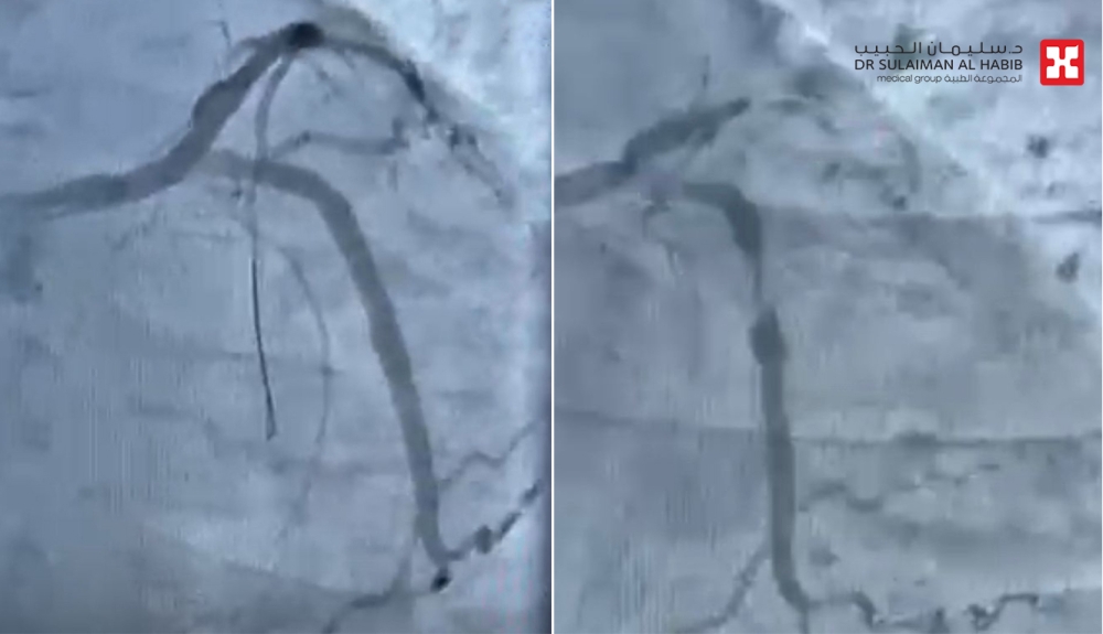 مستشفى الحبيب بالخبر ينقذ حياة مراجع توقف قلبه بسبب انسداد كلي للشريان النازل